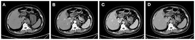 Primary Retroperitoneal Ganglioneuroma: A Retrospective Cohort Study of 32 Patients